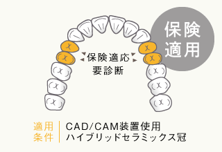 CAD/CAM クラウン